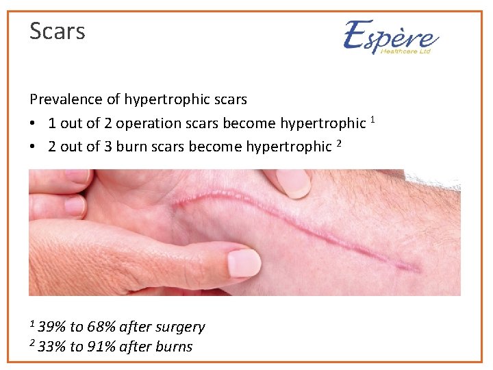 Scars Prevalence of hypertrophic scars • 1 out of 2 operation scars become hypertrophic