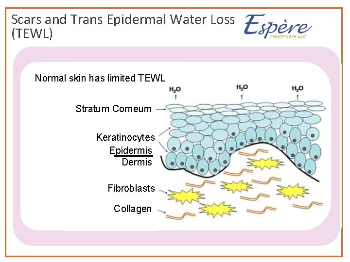 Scars and Trans Epidermal Water Loss (TEWL) Normal skin has limited TEWL Stratum Corneum