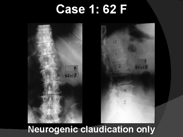 Case 1: 62 F Neurogenic claudication only 