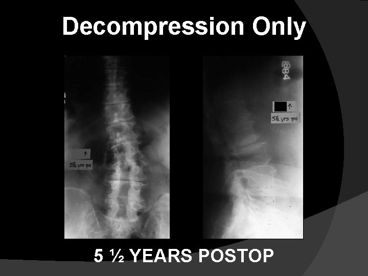 Decompression Only 5 ½ YEARS POSTOP 