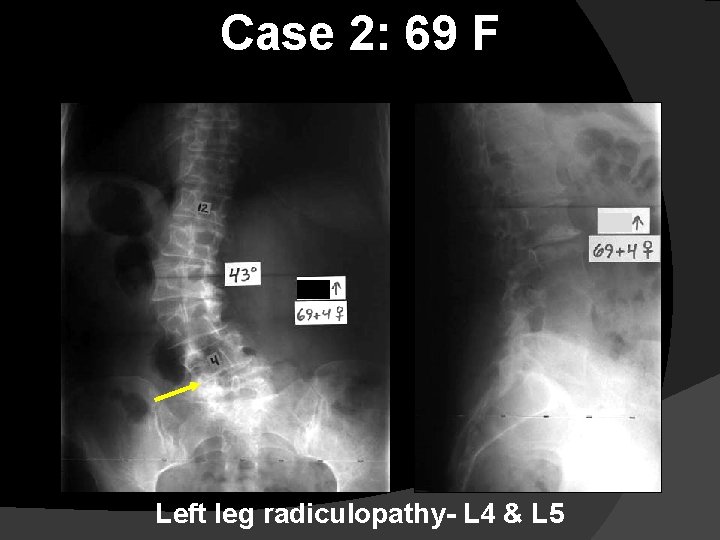 Case 2: 69 F Left leg radiculopathy- L 4 & L 5 