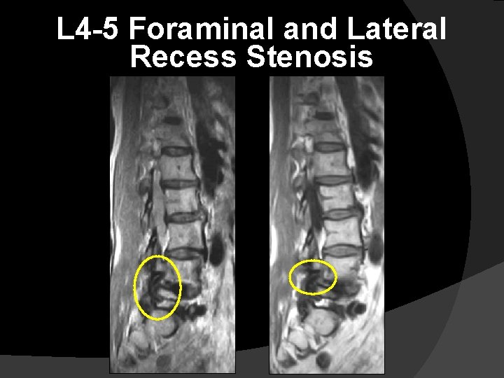 L 4 -5 Foraminal and Lateral Recess Stenosis 