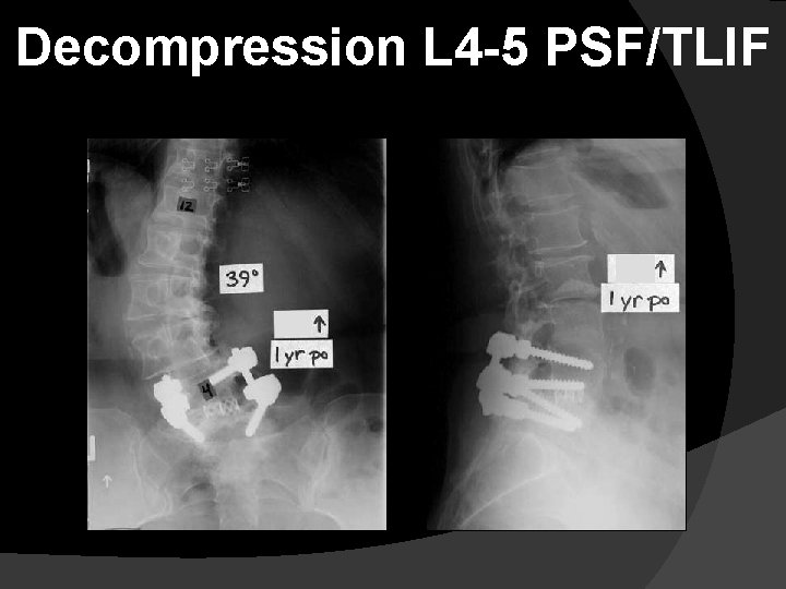 Decompression L 4 -5 PSF/TLIF 