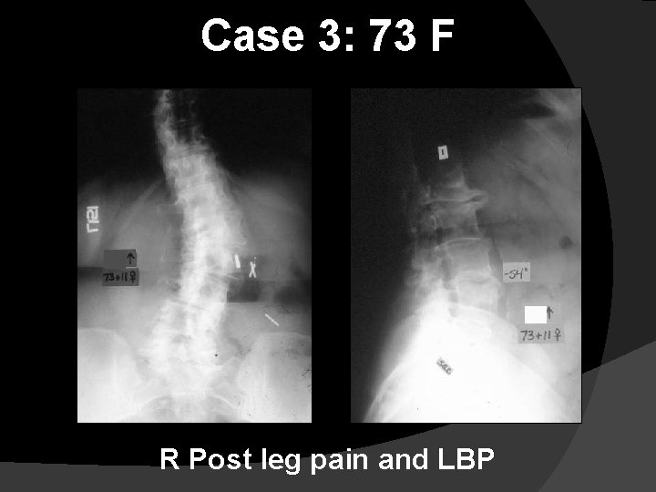 Case 3: 73 F R Post leg pain and LBP 