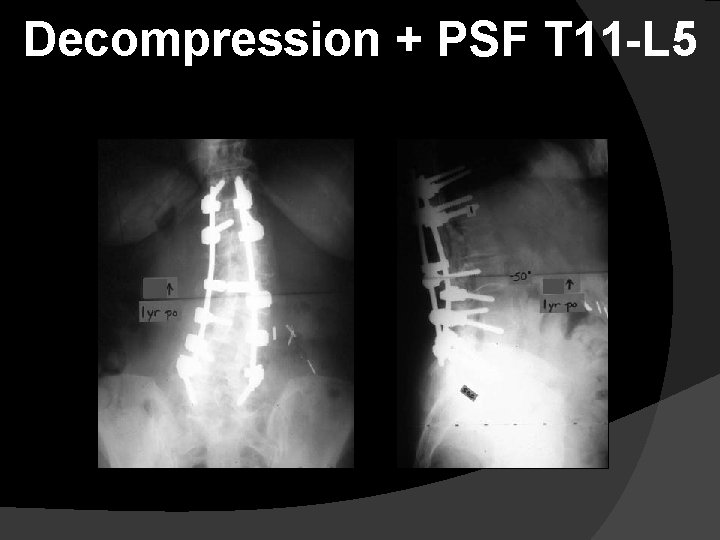 Decompression + PSF T 11 -L 5 