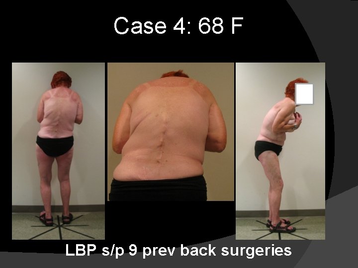 Case 4: 68 F LBP s/p 9 prev back surgeries 