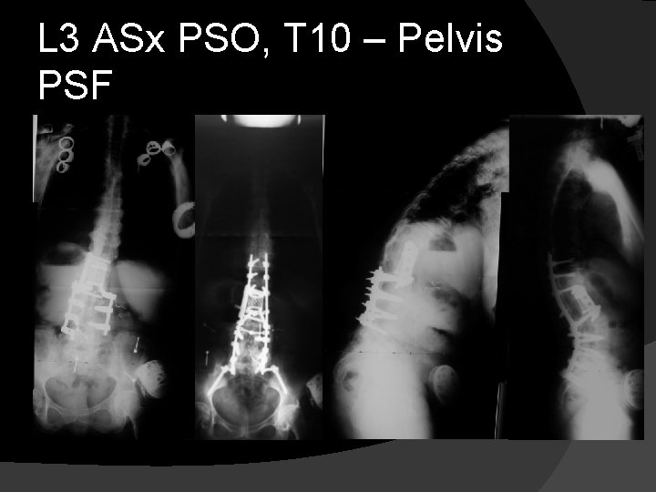 L 3 ASx PSO, T 10 – Pelvis PSF 