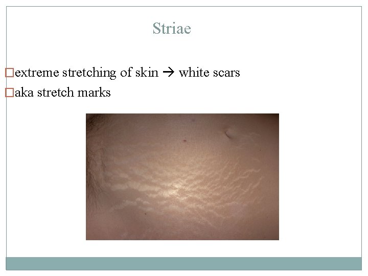Striae �extreme stretching of skin white scars �aka stretch marks 