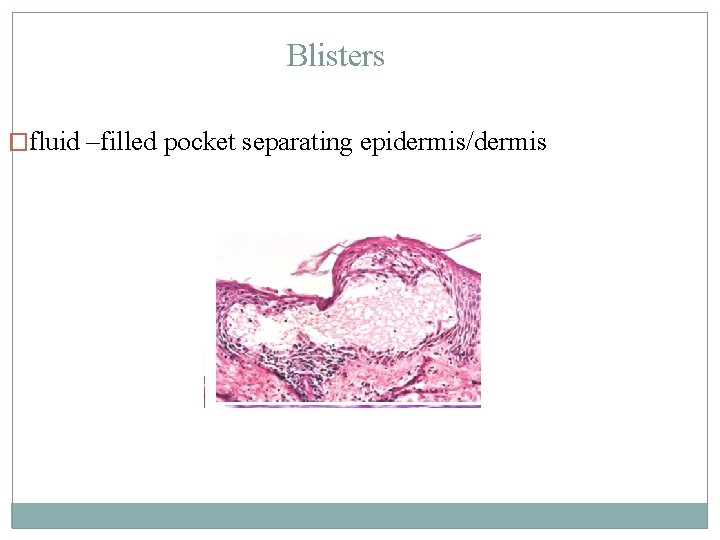 Blisters �fluid –filled pocket separating epidermis/dermis 