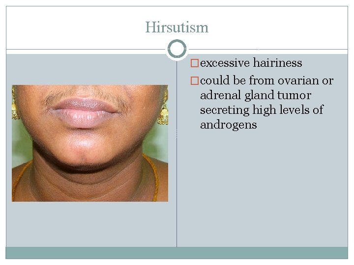Hirsutism �excessive hairiness �could be from ovarian or adrenal gland tumor secreting high levels