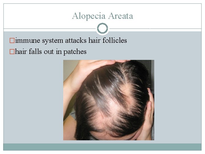 Alopecia Areata �immune system attacks hair follicles �hair falls out in patches 