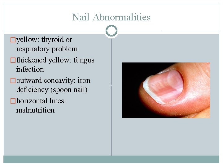 Nail Abnormalities �yellow: thyroid or respiratory problem �thickened yellow: fungus infection �outward concavity: iron