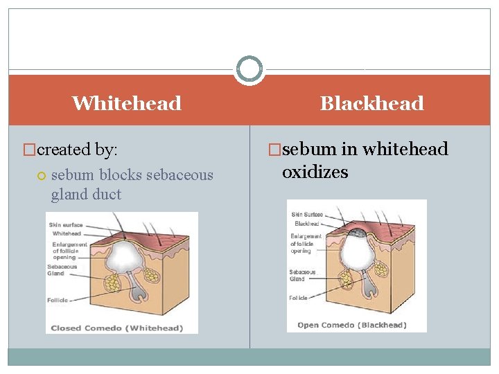 Whitehead �created by: sebum blocks sebaceous gland duct Blackhead �sebum in whitehead oxidizes 