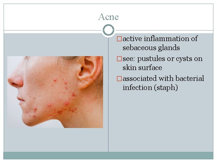 Acne �active inflammation of sebaceous glands �see: pustules or cysts on skin surface �associated