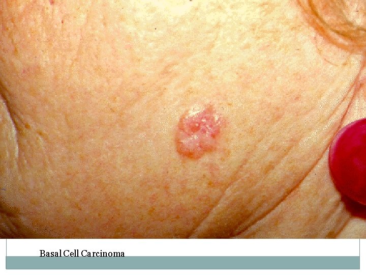 Basal Cell Carcinoma 