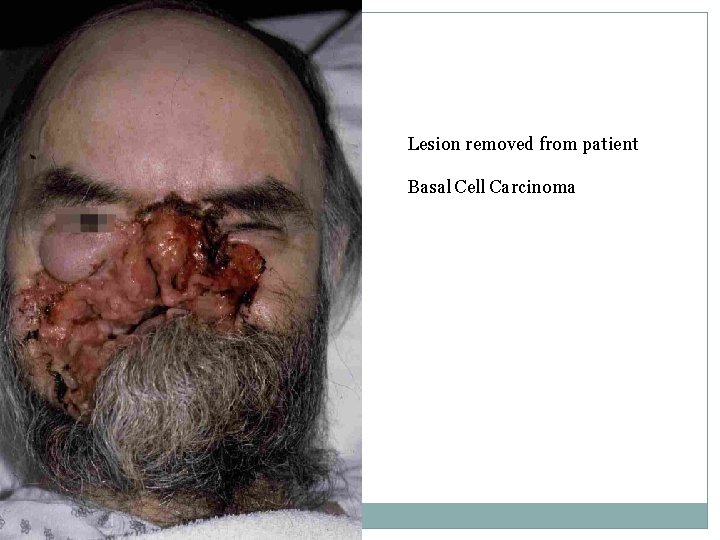 Lesion removed from patient Basal Cell Carcinoma 