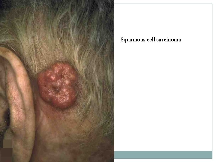 Squamous cell carcinoma 