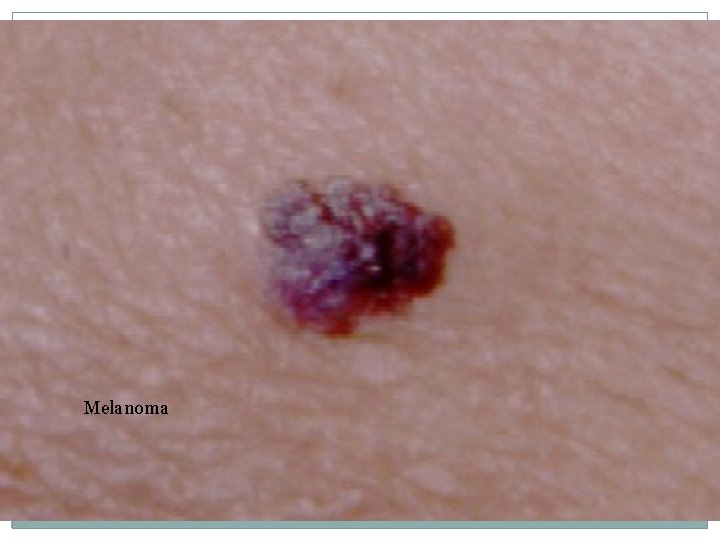 Melanoma 