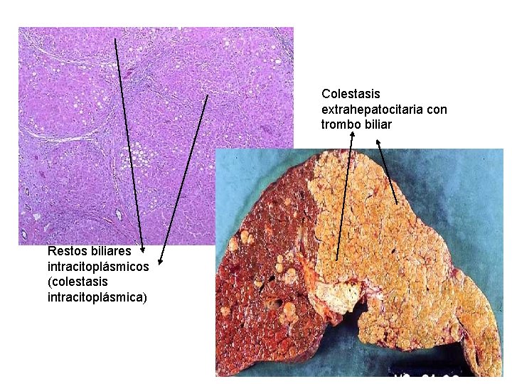 Colestasis extrahepatocitaria con trombo biliar Restos biliares intracitoplásmicos (colestasis intracitoplásmica) 