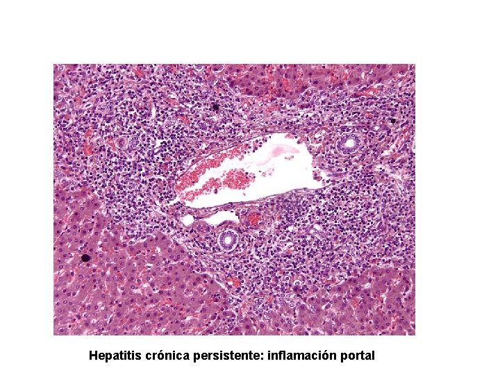 Hepatitis crónica persistente: inflamación portal 