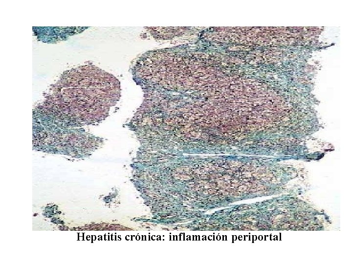 Hepatitis crónica: inflamación periportal 