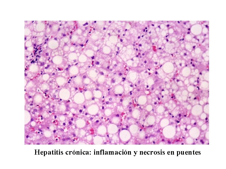 Hepatitis crónica: inflamación y necrosis en puentes 