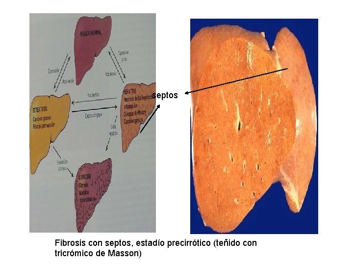 septos Fibrosis con septos, estadío precirrótico (teñido con tricrómico de Masson) 