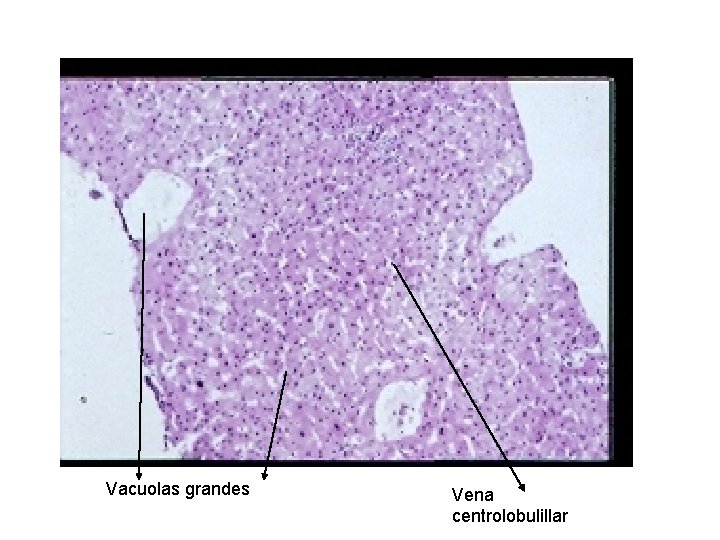 Vacuolas grandes Vena centrolobulillar 