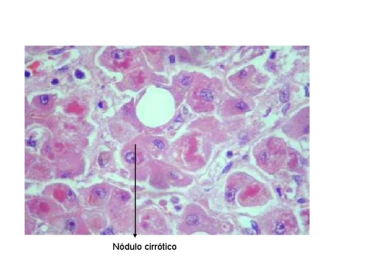 Nódulo cirrótico 