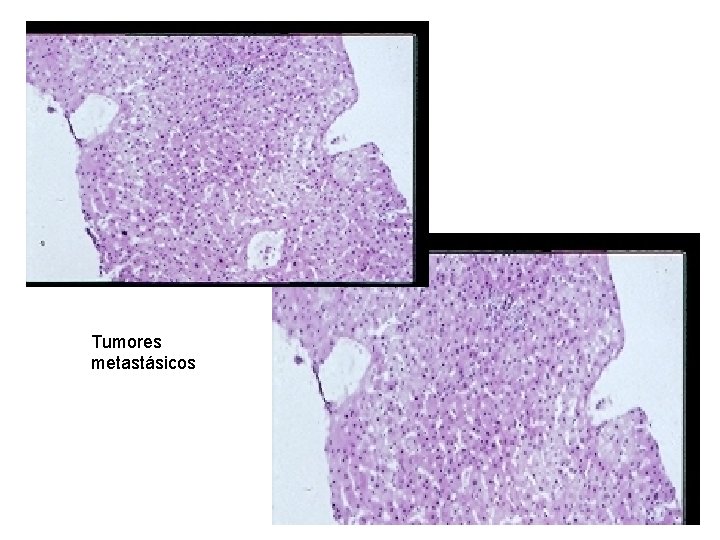 Tumores metastásicos 
