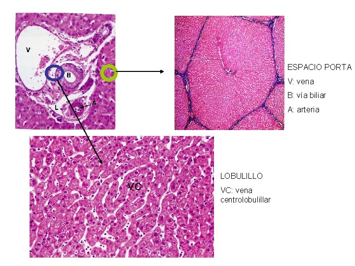 ESPACIO PORTA V: vena B: vía biliar A: arteria vc LOBULILLO VC: vena centrolobulillar