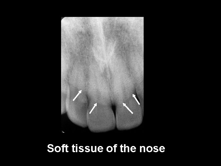 Soft tissue of the nose 