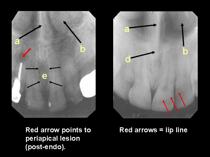 a a b d b e Red arrow points to periapical lesion (post-endo). Red