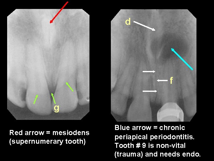 d f g Red arrow = mesiodens (supernumerary tooth) Blue arrow = chronic periapical
