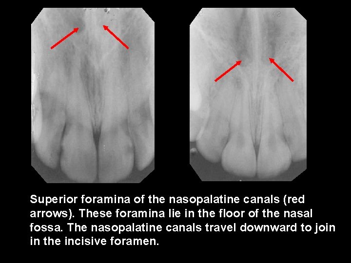 Superior foramina of the nasopalatine canals (red arrows). These foramina lie in the floor