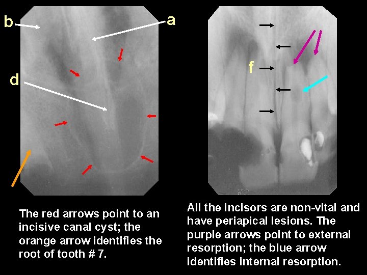 a b d The red arrows point to an incisive canal cyst; the orange