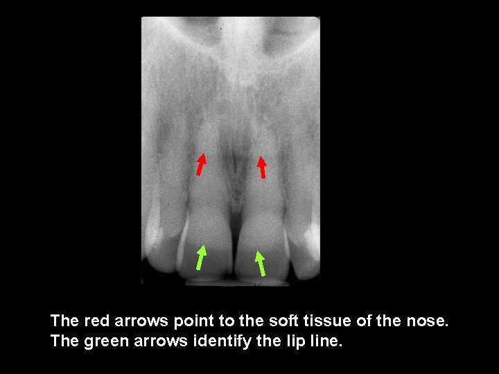 The red arrows point to the soft tissue of the nose. The green arrows