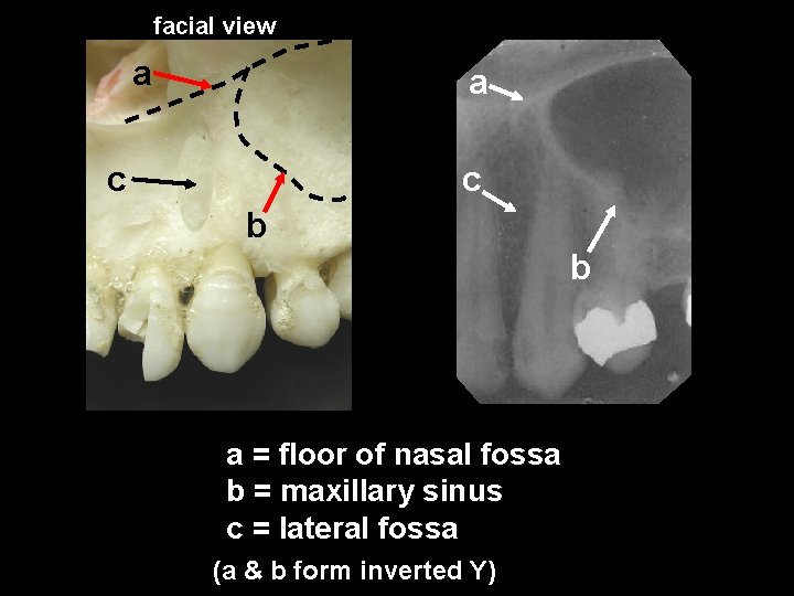 facial view a a c c b b a = floor of nasal fossa