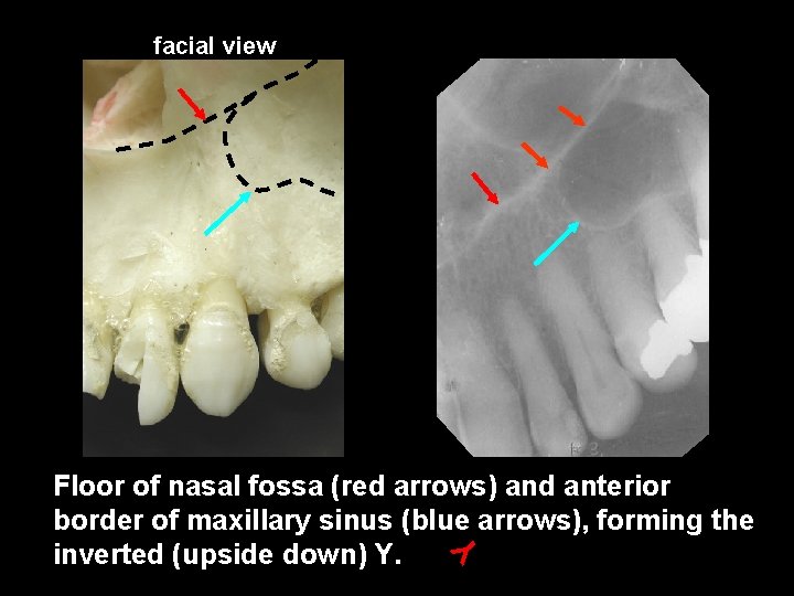facial view Y Floor of nasal fossa (red arrows) and anterior border of maxillary