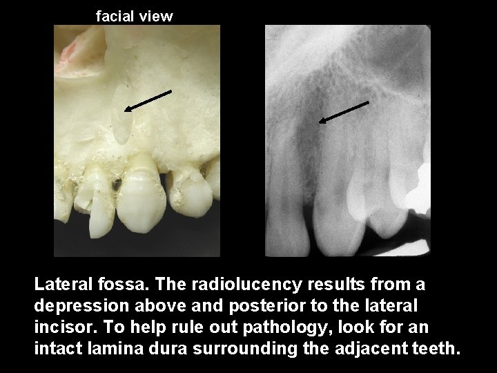 facial view Lateral fossa. The radiolucency results from a depression above and posterior to
