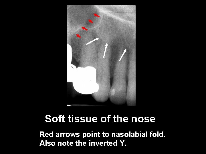 Soft tissue of the nose Red arrows point to nasolabial fold. Also note the