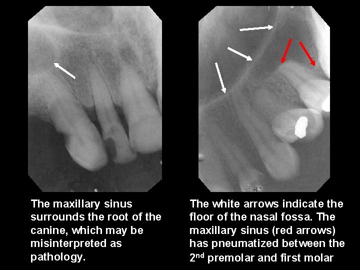 The maxillary sinus surrounds the root of the canine, which may be misinterpreted as