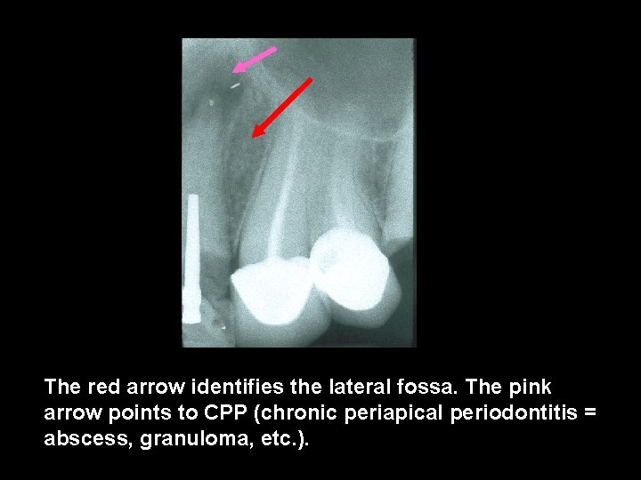 The red arrow identifies the lateral fossa. The pink arrow points to CPP (chronic