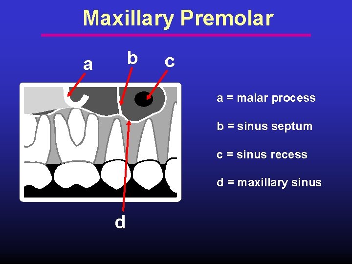 Maxillary Premolar b a c a = malar process b = sinus septum c