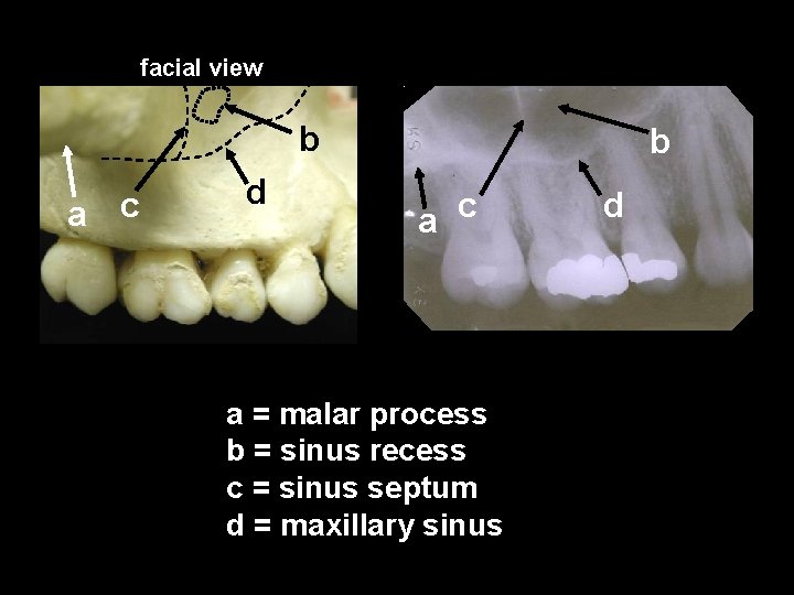 facial view b a c d b a c a = malar process b