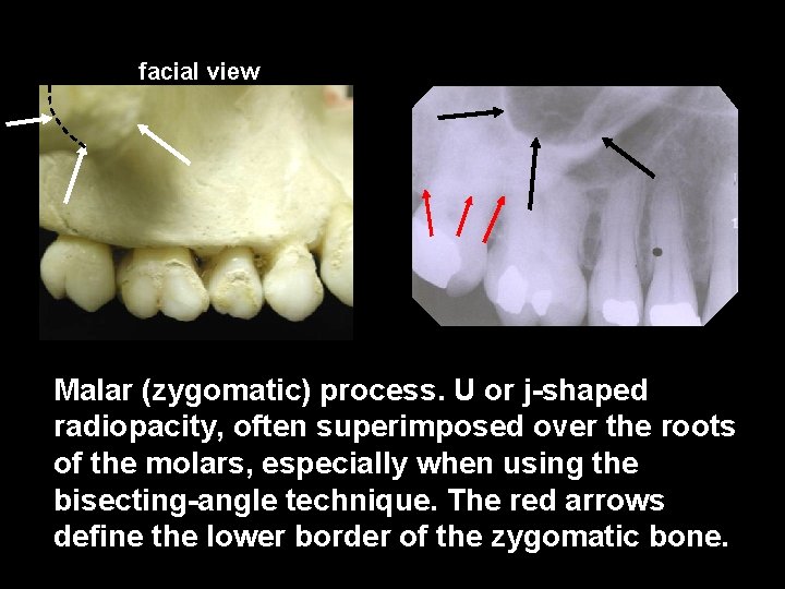 facial view Malar (zygomatic) process. U or j-shaped radiopacity, often superimposed over the roots