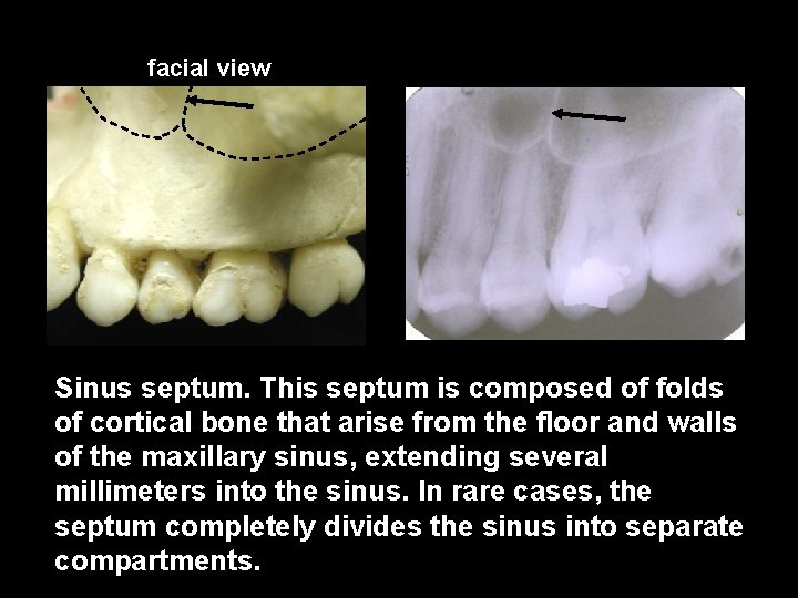 facial view Sinus septum. This septum is composed of folds of cortical bone that