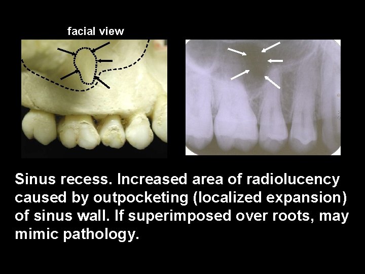 facial view Sinus recess. Increased area of radiolucency caused by outpocketing (localized expansion) of