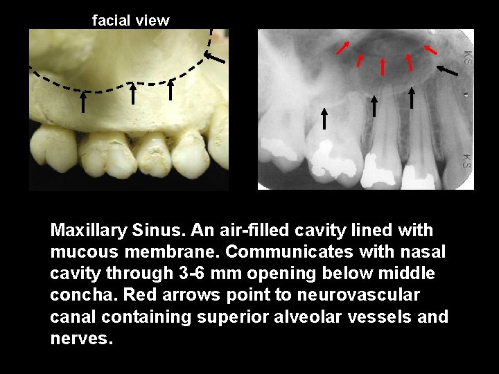 facial view Maxillary Sinus. An air-filled cavity lined with mucous membrane. Communicates with nasal