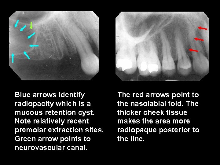 Blue arrows identify radiopacity which is a mucous retention cyst. Note relatively recent premolar